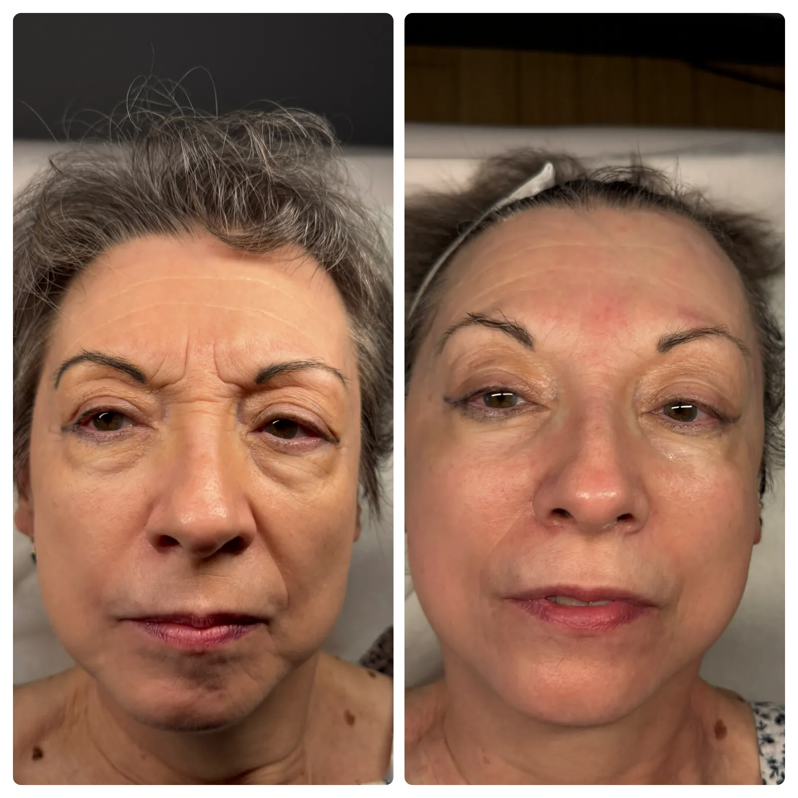 Natural Facelift before and after results showing smoother, more radiant skin