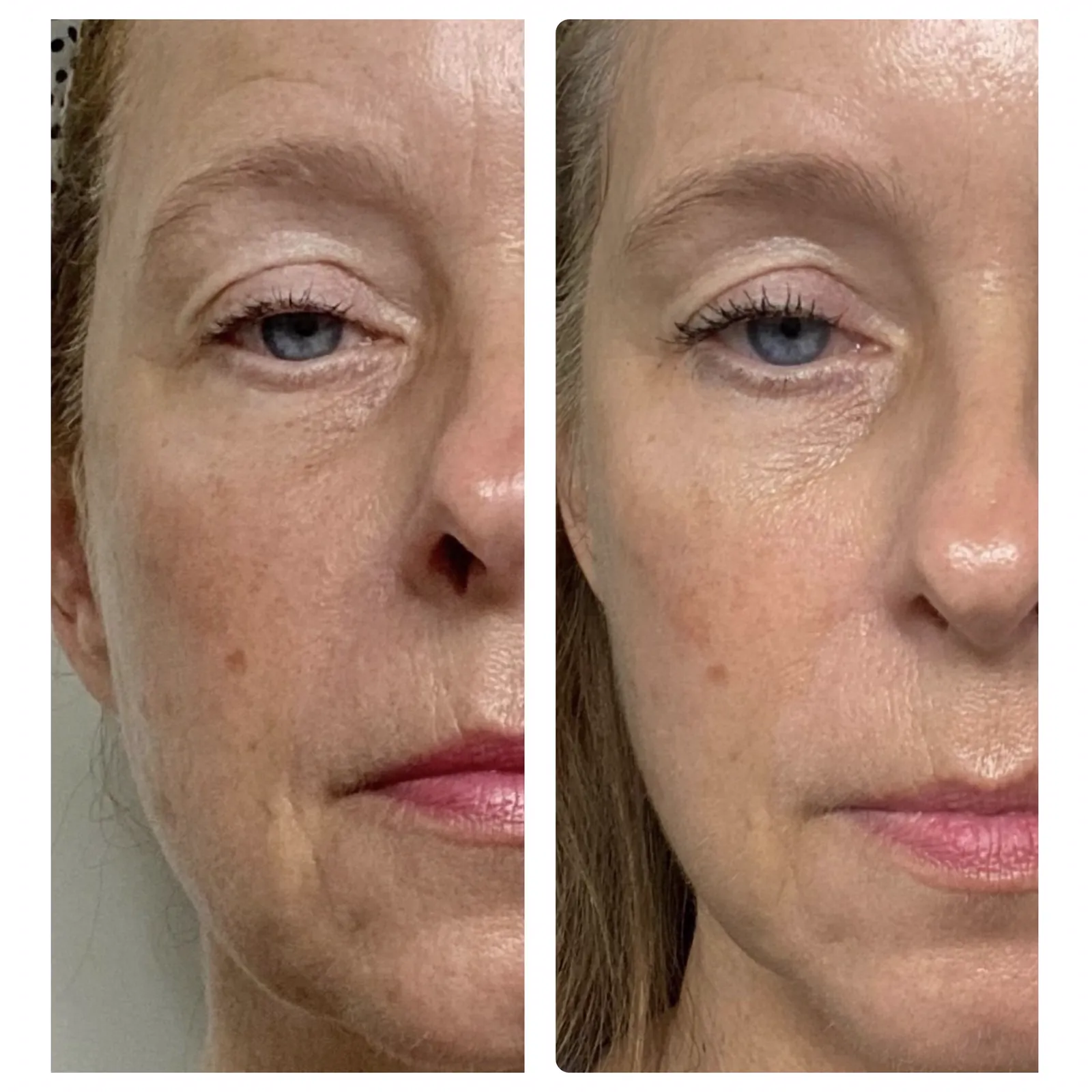 Red Light Therapy Facial before and after results showing improved skin texture and brightness