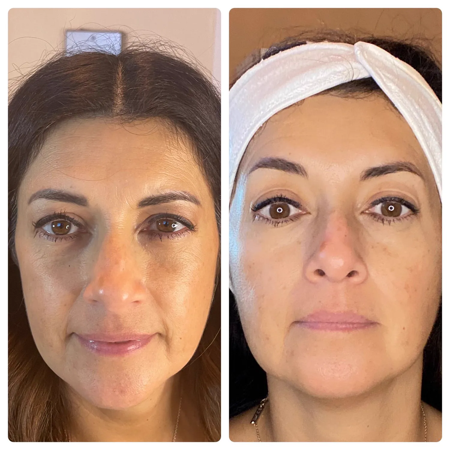 Express Natural Facelift before and after on a Below Zero Spa client